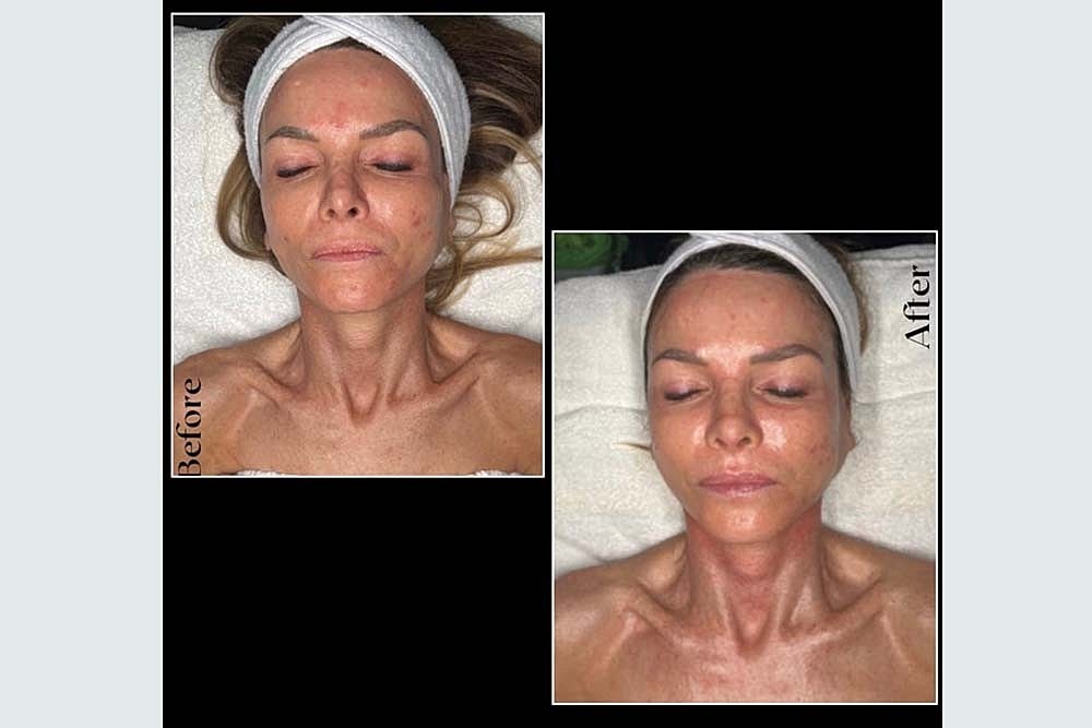 RESURFACE LAST YEAR AWAY NEW YEAR BETTER SKIN - Image 6
