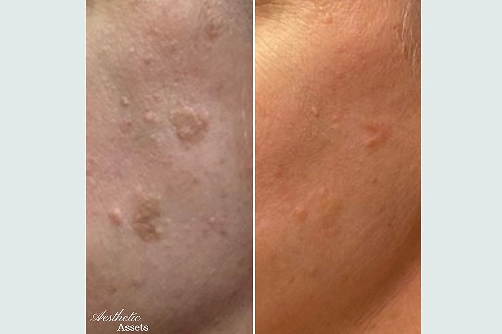 RESURFACE LAST YEAR AWAY NEW YEAR BETTER SKIN - Image 7