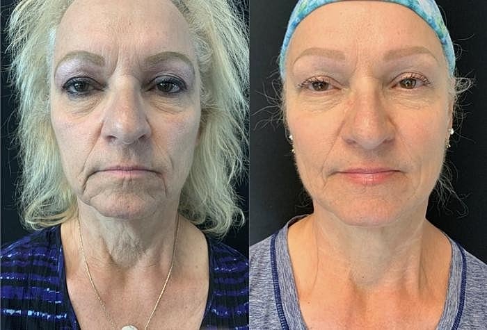Rewind the Hands of Time with Sculptra & Bellafill – Our Go-To Biostimulators. - Image 2