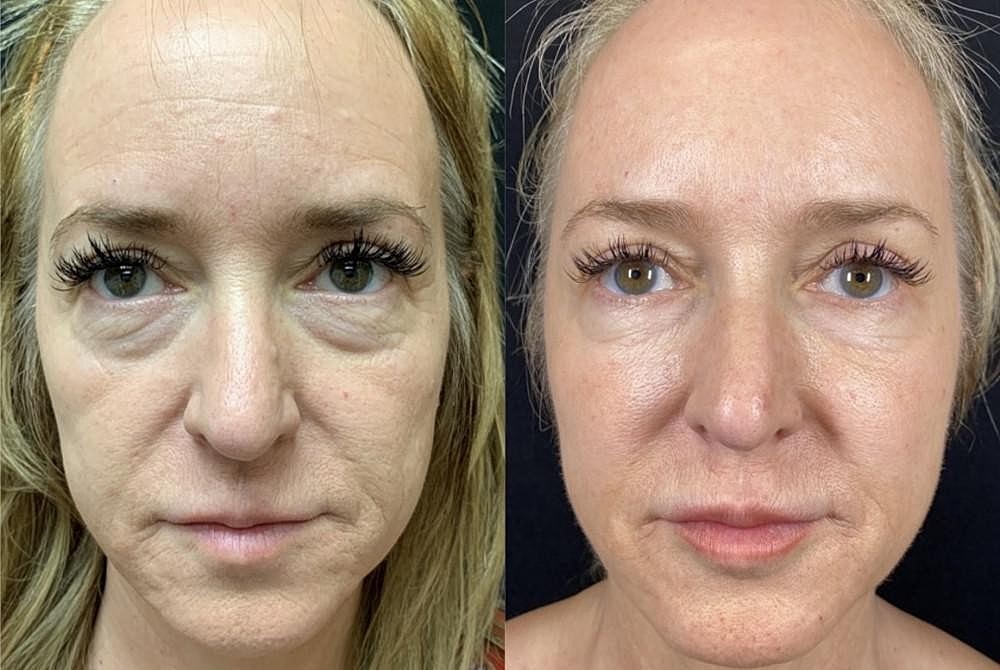 Rewind the Hands of Time with Sculptra & Bellafill - Our Go-To Biostimulators.
