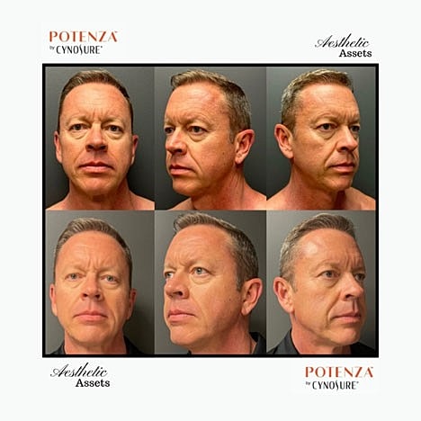 RF Microneedling with Potenza