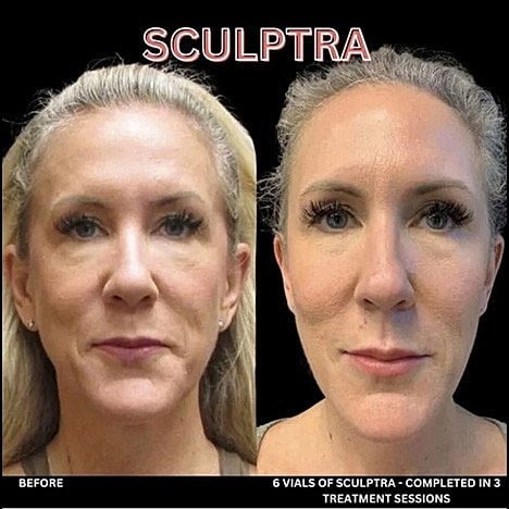 Sculptra: The Revolutionary Approach to Facial Rejuvenation