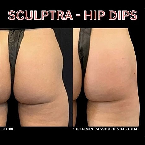 Sculptra: The Revolutionary Approach to Facial Rejuvenation - Image 2