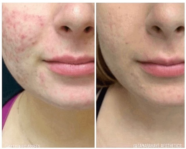 Solutions for Stretch Marks and Surgical Scars - Image 2
