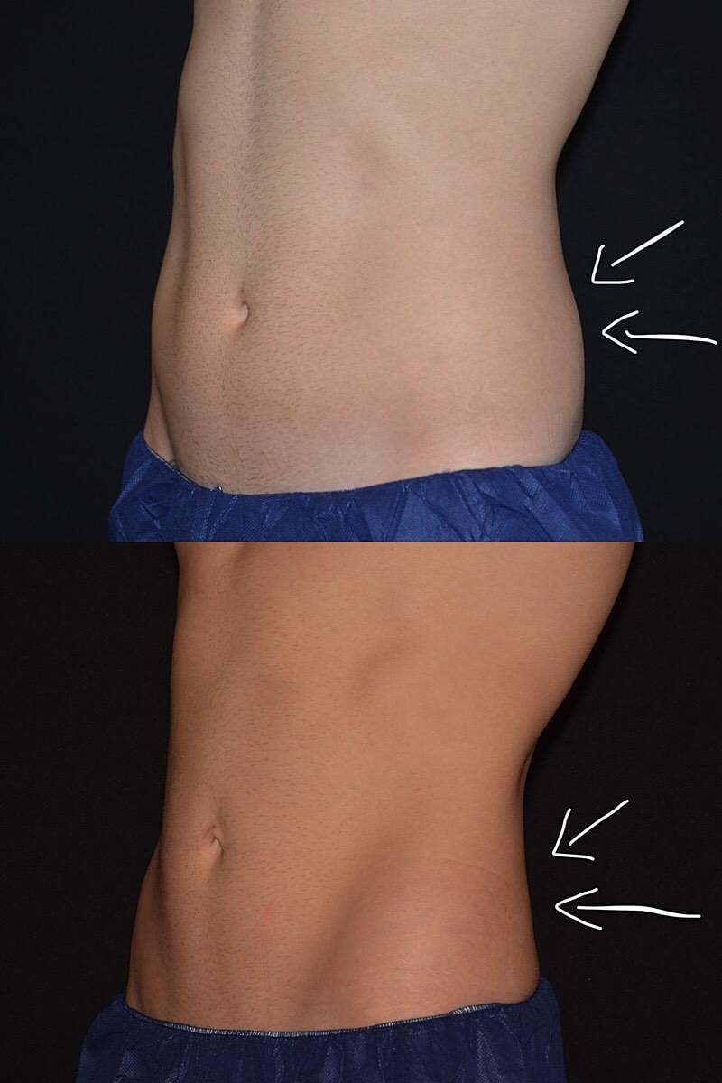 The Benefits of Nonsurgical Body Sculpting With CoolSculpting® Elite and Accufit™ - Image 2