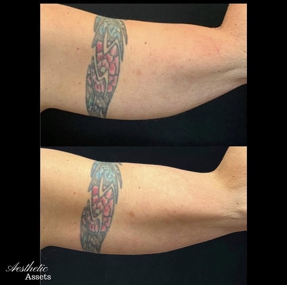 The Benefits of Nonsurgical Body Sculpting With CoolSculpting® Elite and Accufit™ - Image 3