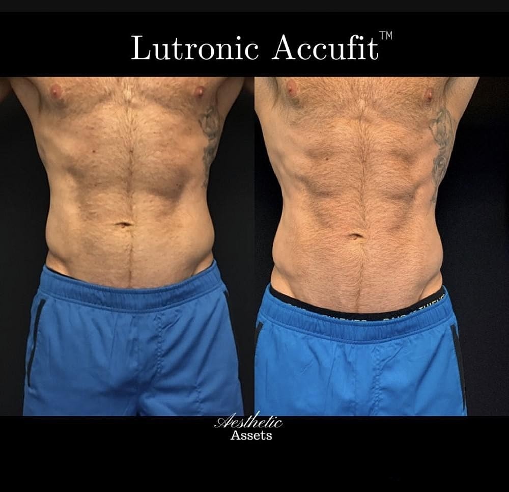 The Benefits of Nonsurgical Body Sculpting With CoolSculpting® Elite and Accufit™ - Image 4