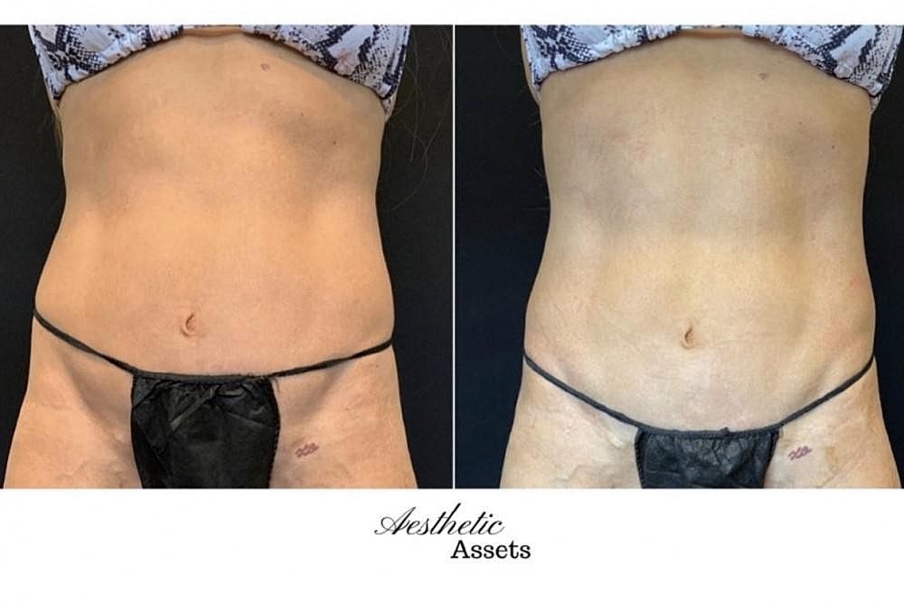 The Benefits of Nonsurgical Body Sculpting With CoolSculpting® Elite and Accufit™ - Image 5