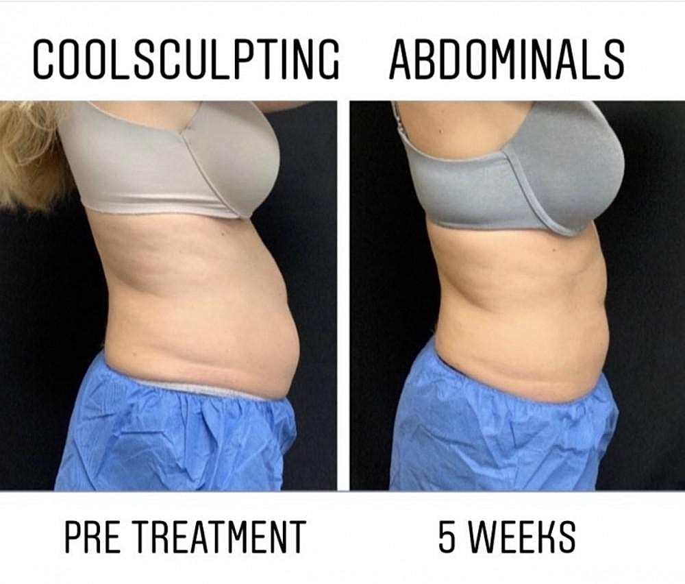 The Benefits of Nonsurgical Body Sculpting With CoolSculpting® Elite and Accufit™