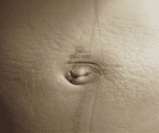 The Genius Way to Get Rid of Stretch Marks - Image 2