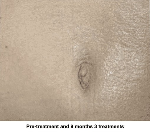 The Genius Way to Get Rid of Stretch Marks - Image 3