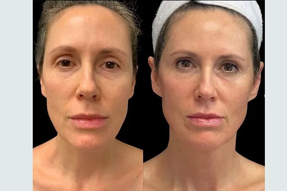 Tighten and Brighten Your Skin for the Holidays With The Total Skin Solution by Lutronic