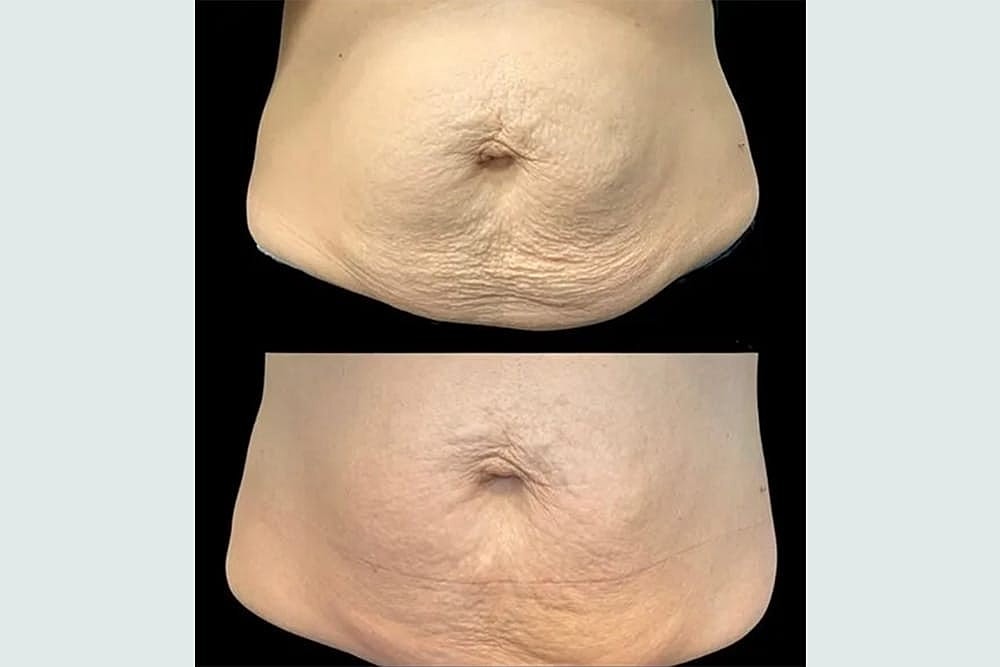 Tighten and Brighten Your Skin for the Holidays With The Total Skin Solution by Lutronic - Image 2