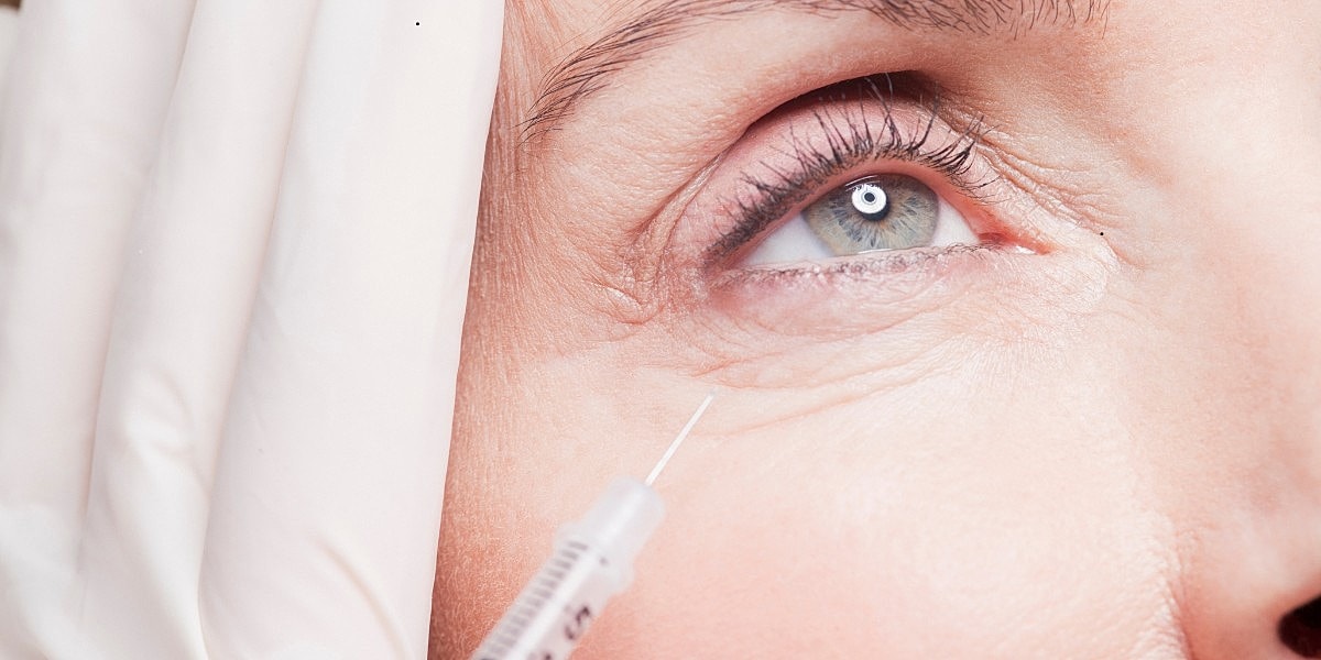 Under-Eye Filler for HollowsWhat It Fixes and What It Can’t