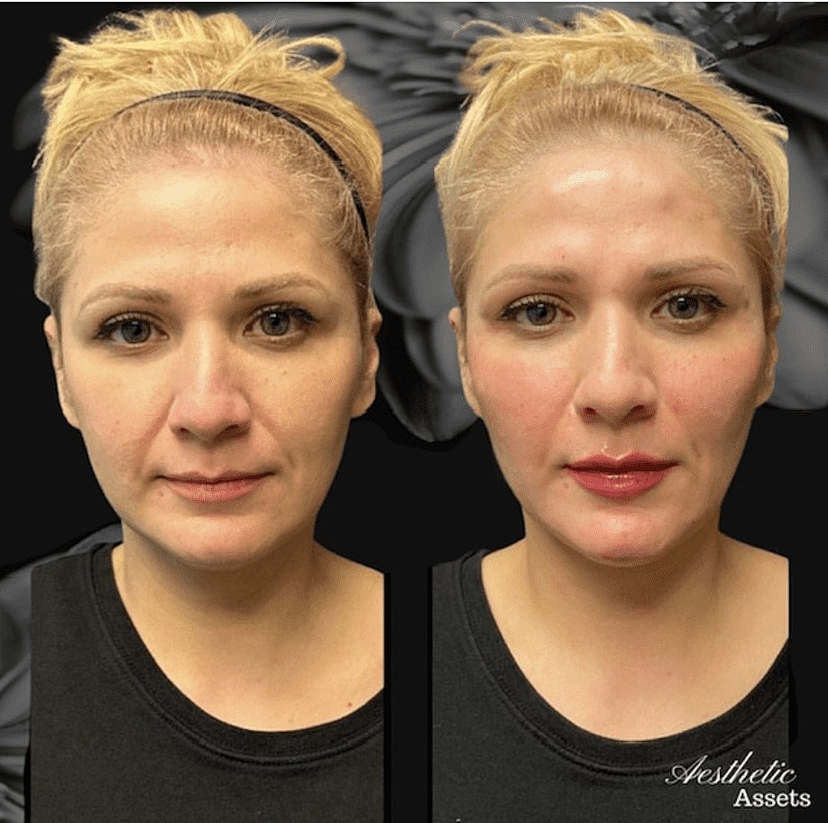 What Are HA Fillers and How Do They Work? - Image 2