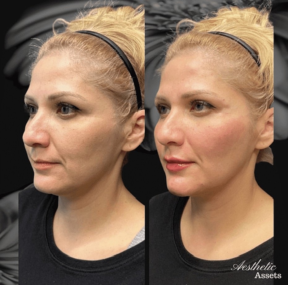 What Are HA Fillers and How Do They Work? - Image 3