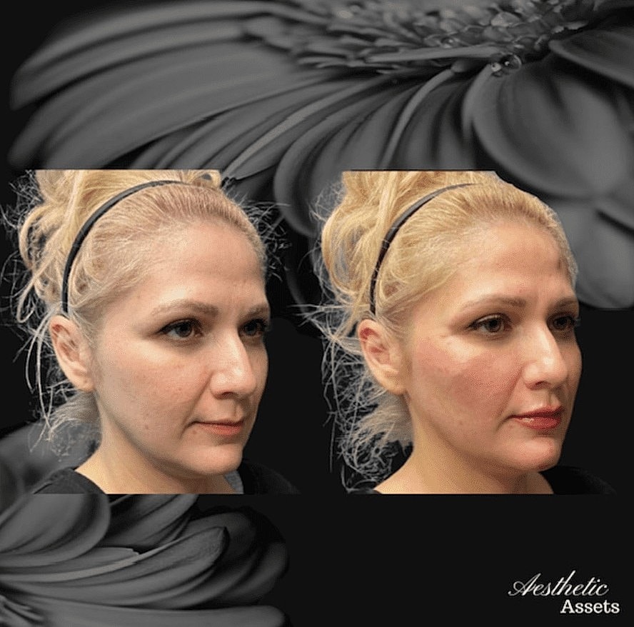 What Are HA Fillers and How Do They Work? - Image 4