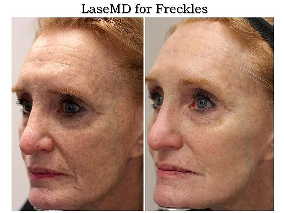 What Is LaseMD™? - Image 2