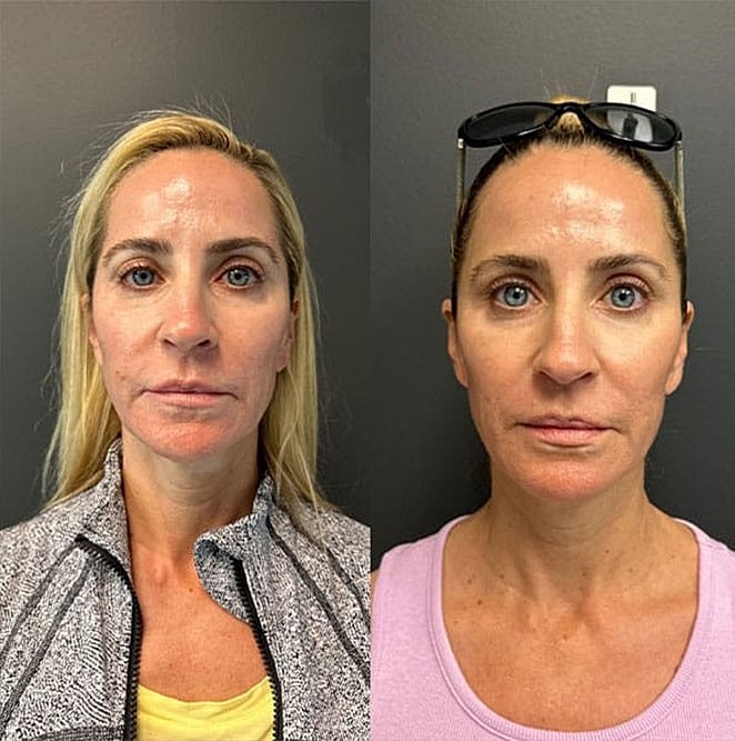 What is Ozempic Face? Read on to Learn How to Combat it! - Image 2