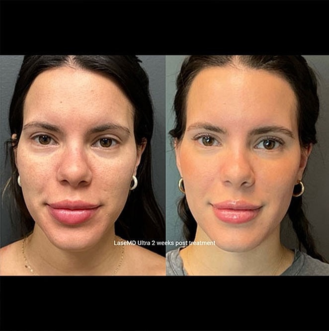 What is Ozempic Face? Read on to Learn How to Combat it! - Image 3