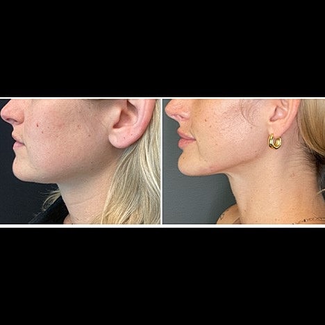 What is the best non-surgical treatment for Jowls, Jawline and Neck? - Image 2