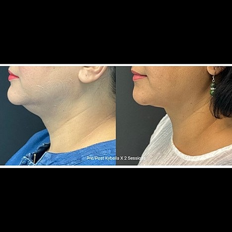 What is the best non-surgical treatment for Jowls, Jawline and Neck? - Image 3
