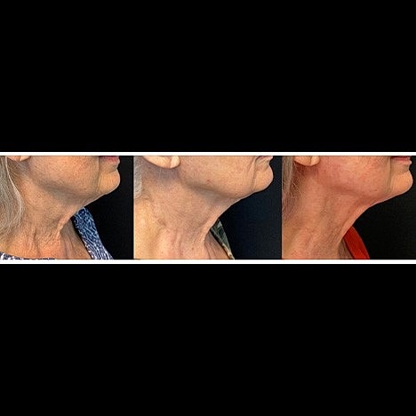 What is the best non-surgical treatment for Jowls, Jawline and Neck? - Image 4