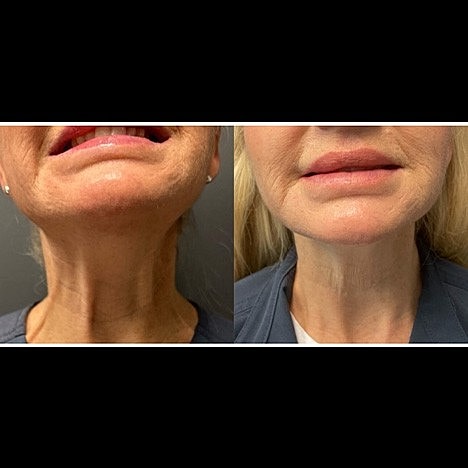 What is the best non-surgical treatment for Jowls, Jawline and Neck? - Image 5