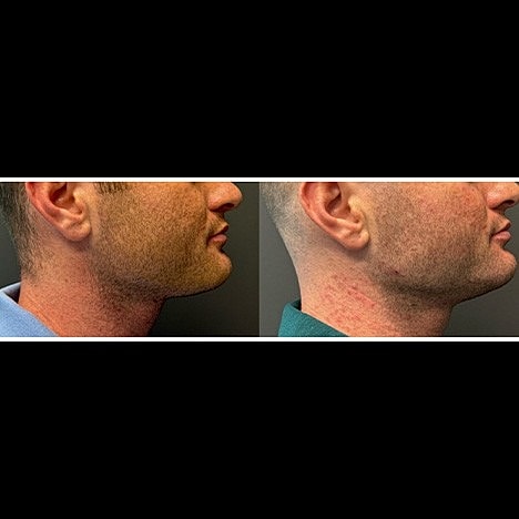 What is the best non-surgical treatment for Jowls, Jawline and Neck? - Image 6