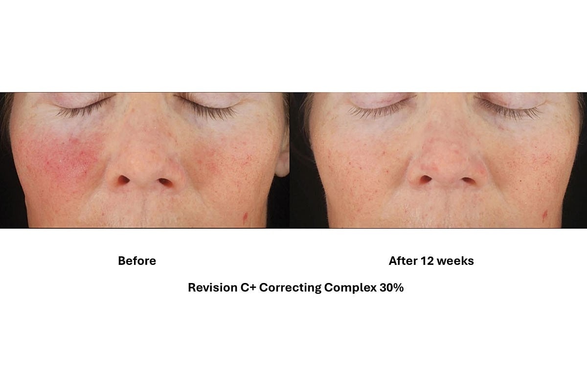 What is the difference between Medical Grade and Over the Counter Skincare Products? - Image 2