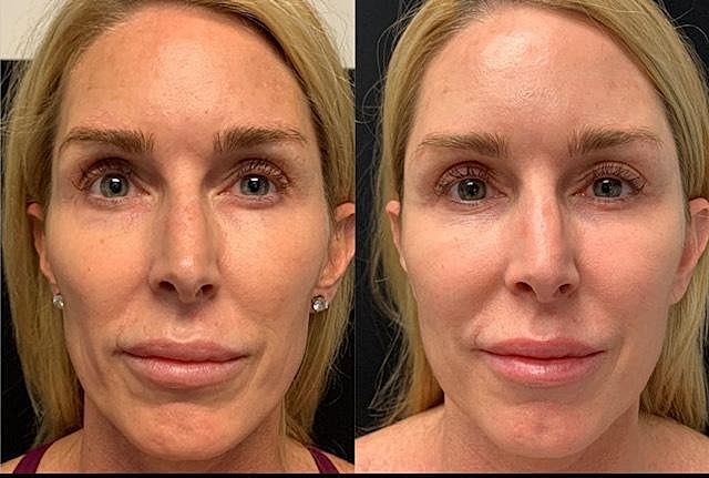 Your Nonsurgical, 3D Facelift Options - Image 2