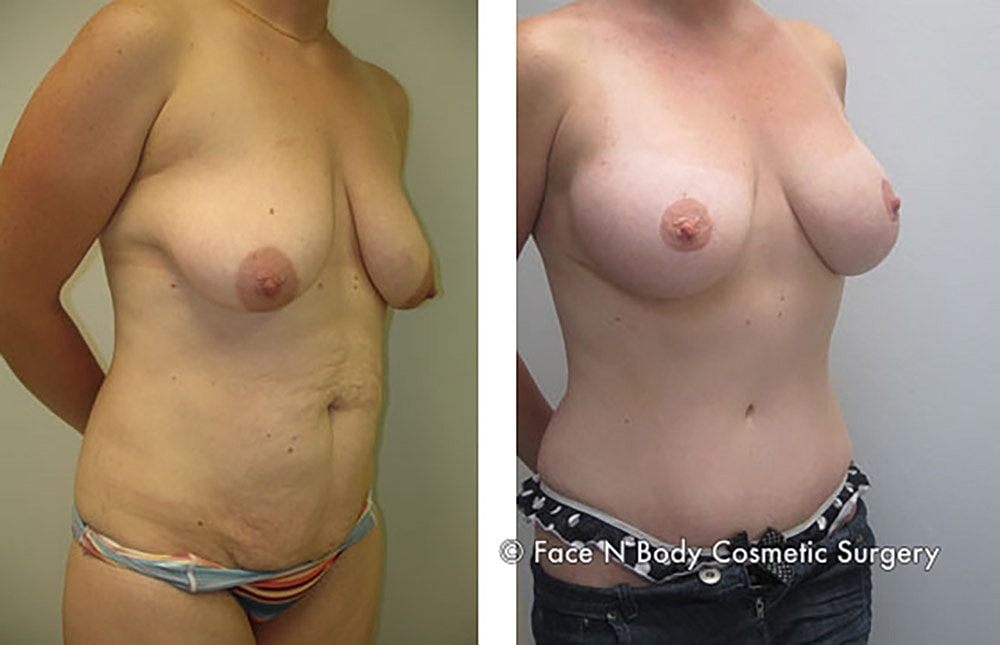 Mommy Makeover Before & After