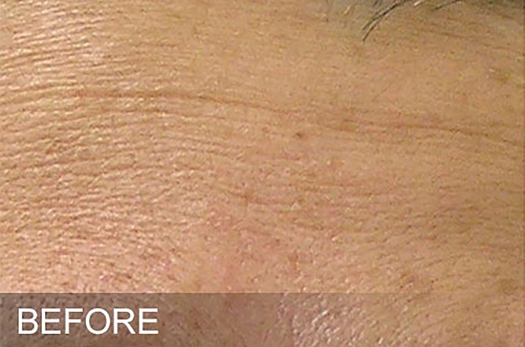 Hydrafacial Before & After