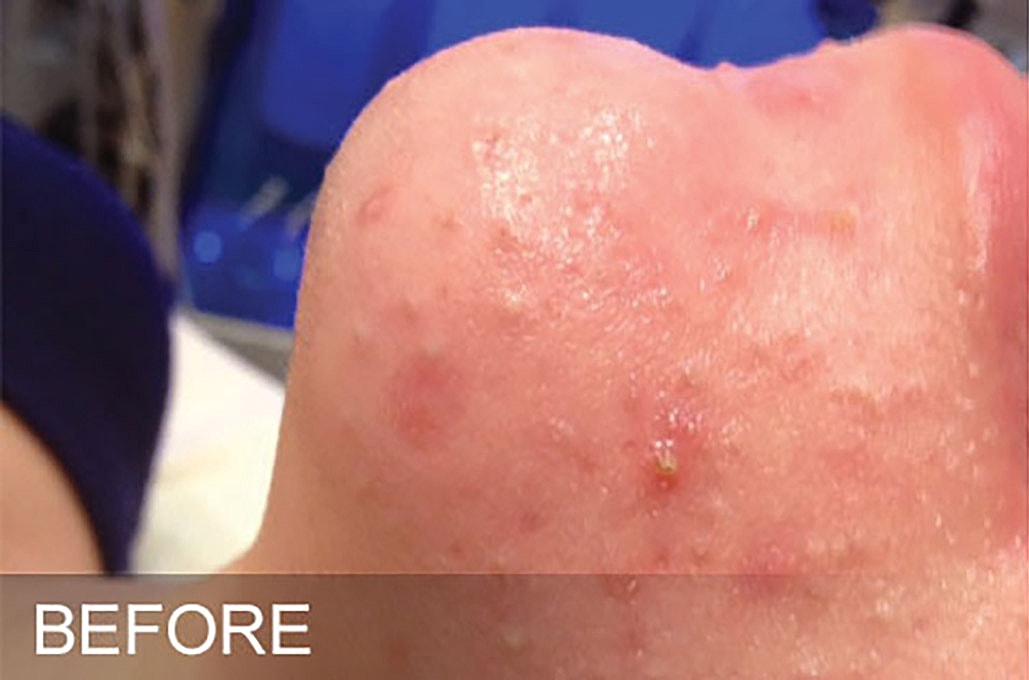Hydrafacial Before & After