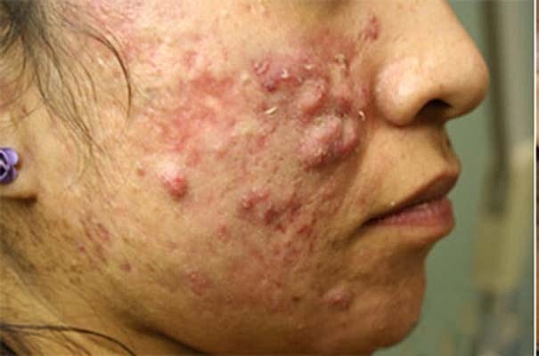 Laser Skin Treatments Before & After