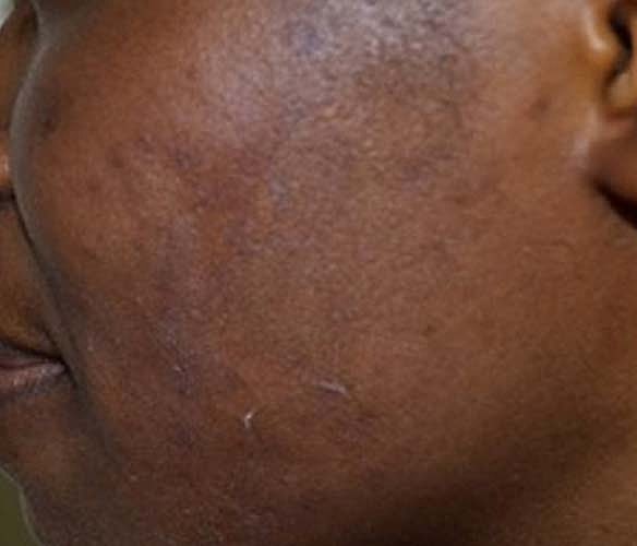 Laser Skin Treatments Before & After
