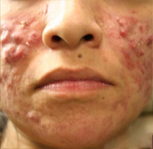 Laser Skin Treatments Before & After