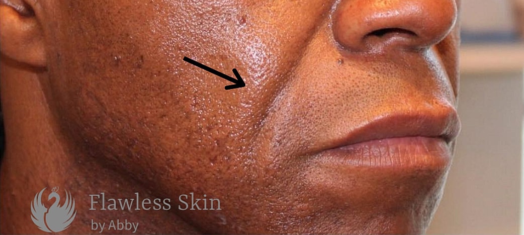 Smile Lines And Nasolabial Fold Fillers Before & After