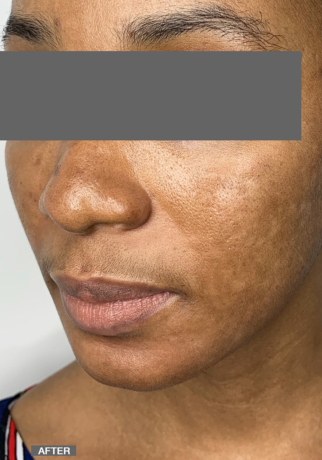 Specialty Peels Before & After