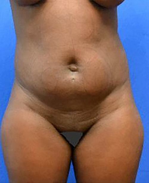 Liposuction Before & After