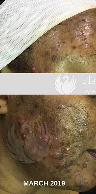 Acne Facial Procedure Before & After