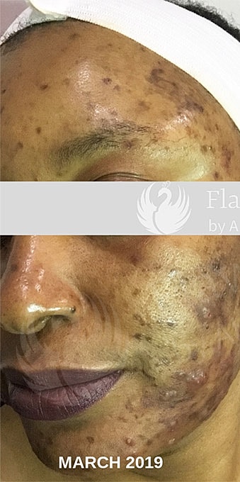 Acne Facial Procedure Before & After