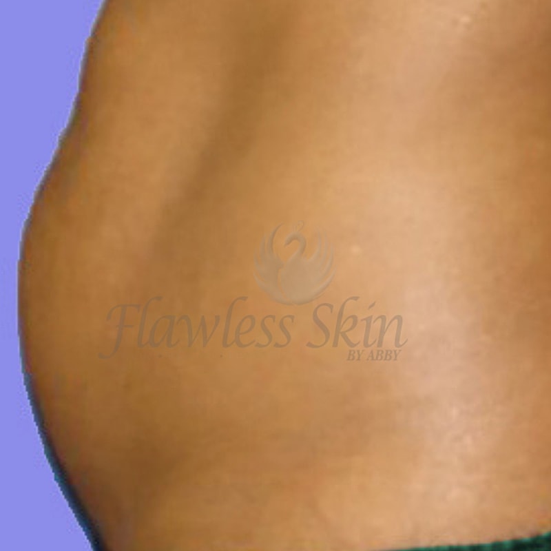 Tummy Tuck Before & After