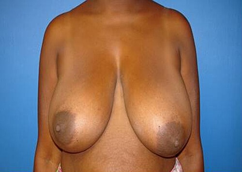 Breast Augmentation And Breast Lift Before & After