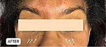 Tear Trough And Under Eye Fillers Before & After