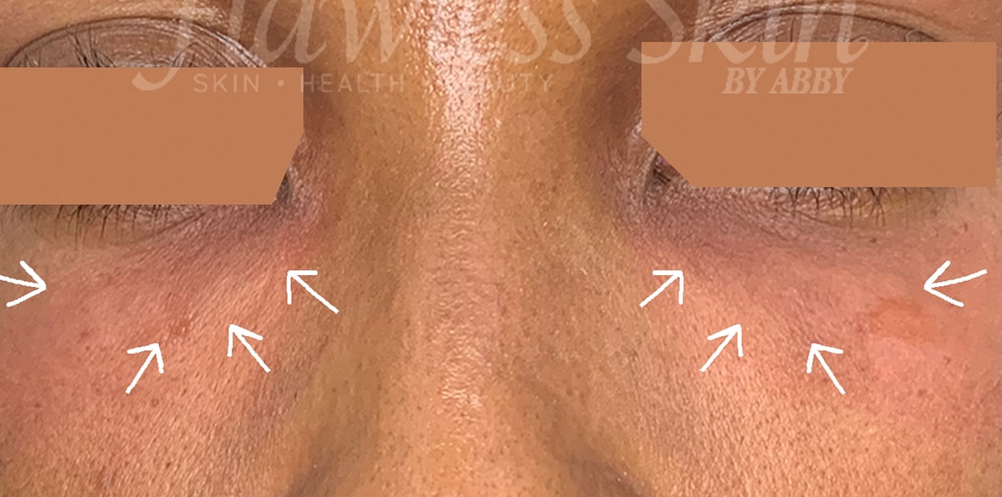Tear Trough And Under Eye Fillers Before & After
