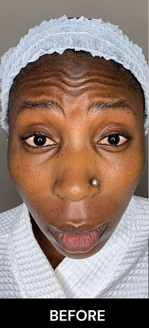 Botox Before & After