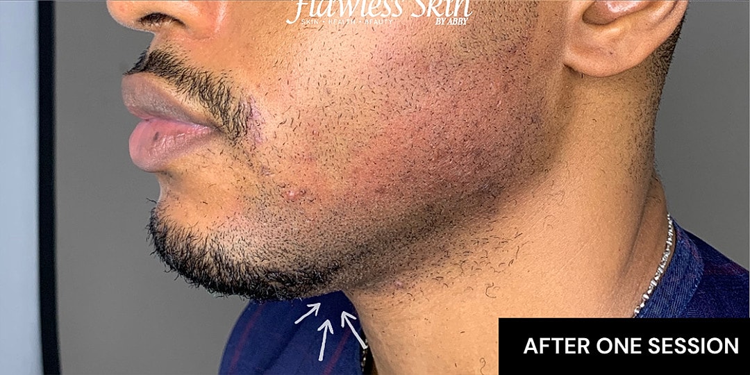 Chin Augmentation And Kybella Before & After