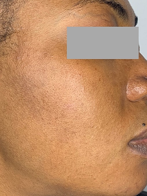 Skin Resurgacing Before & After