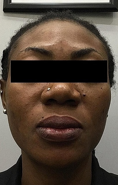 Microneedling With Prp Before & After